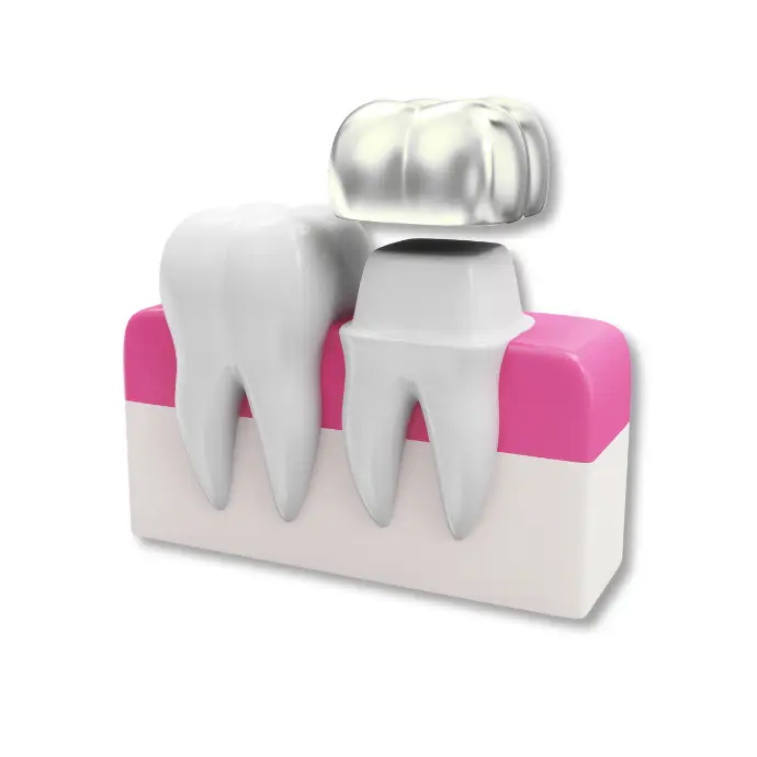 Selection of different dental crown materials
