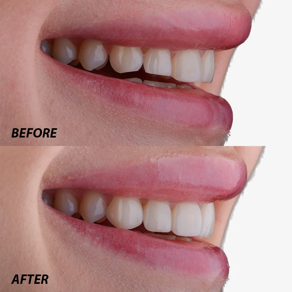 Before and After Porcelain Veneers