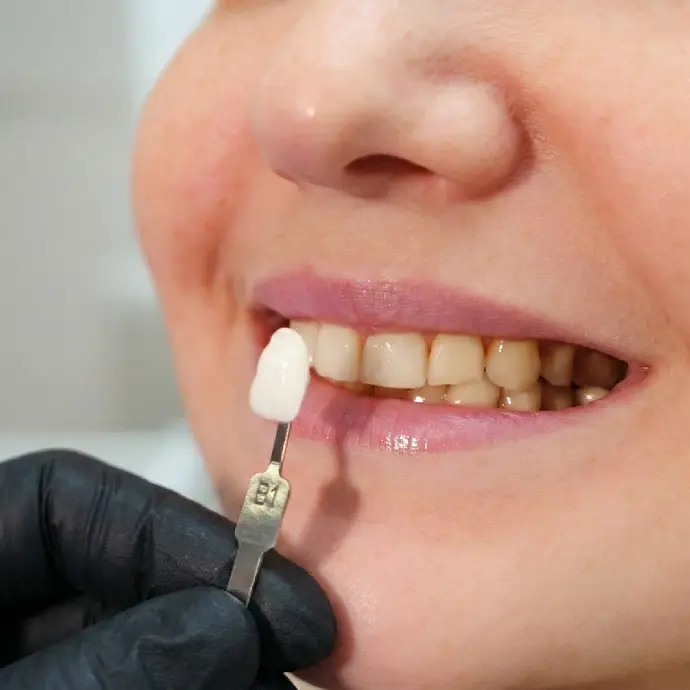 Dental professional preparing veneers for patient
