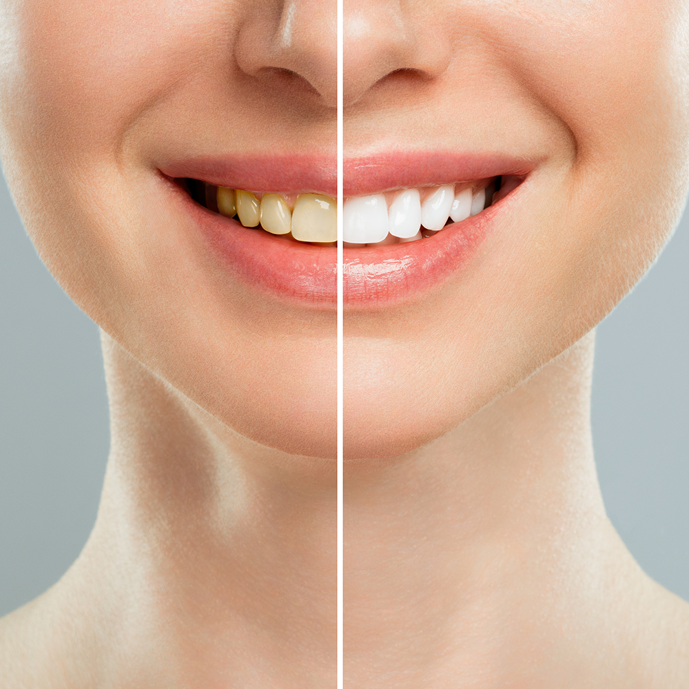 Before and After Teeth Whitening