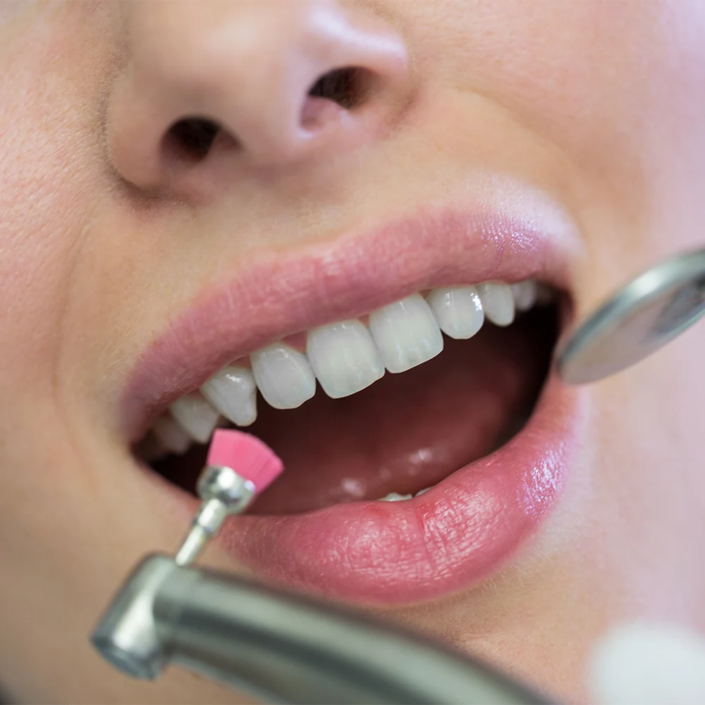 Dentist carefully placing tooth-colored filling
