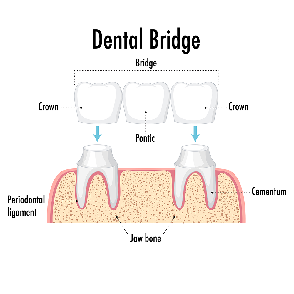 An illustration of dental bridge