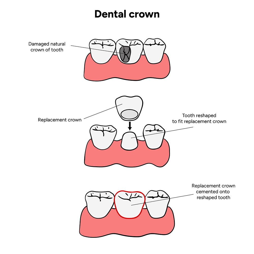 An illustration of a dental crown
