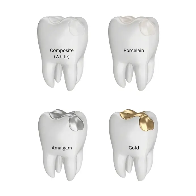 Comparison of different dental filling materials