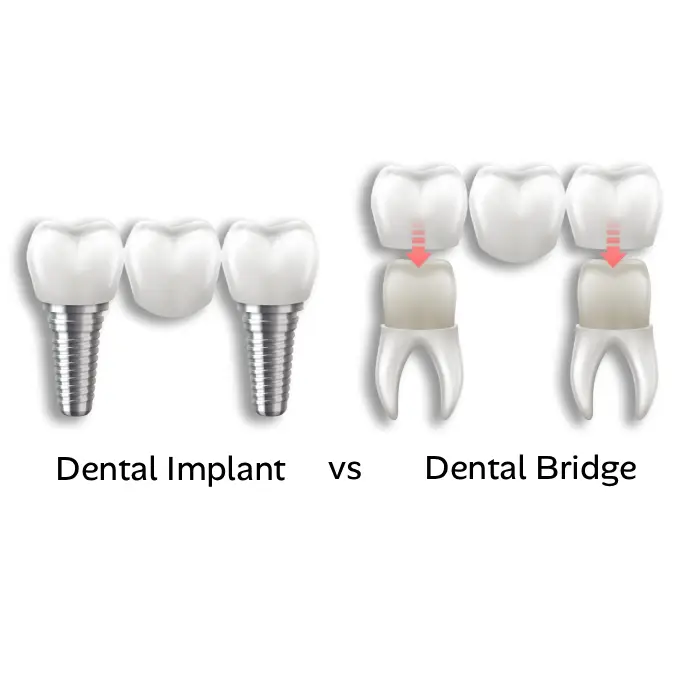 Side-by-side comparison of dental bridge and implant