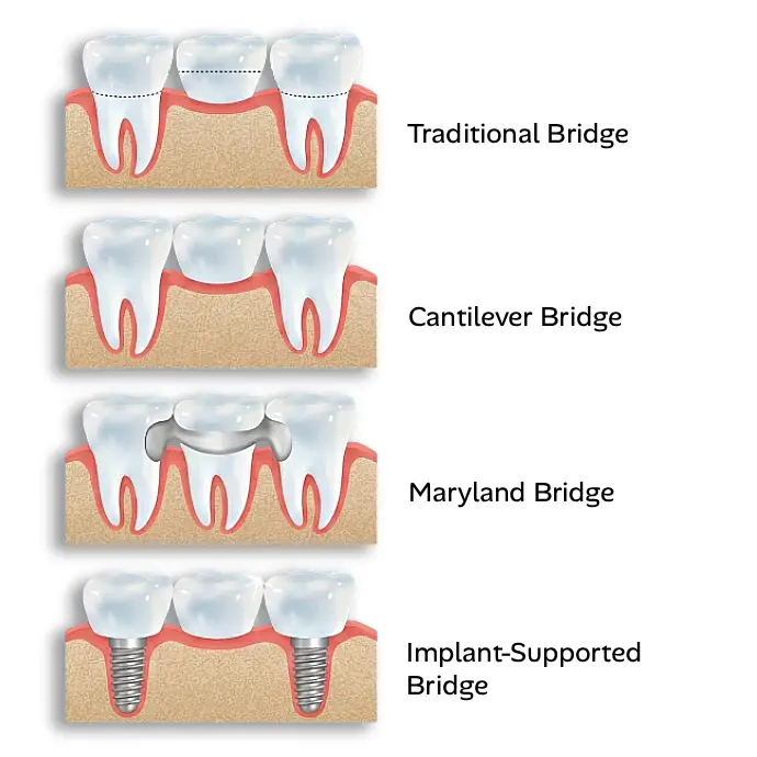 Comparison of different dental bridge types