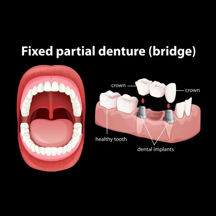 Diagram showing how a dental bridge fills a gap between teeth