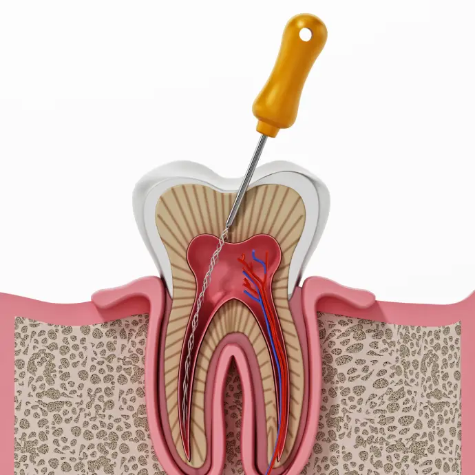 Diagram showing root canal anatomy and procedure